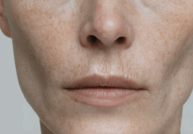 Formation des rides, effet tenseur