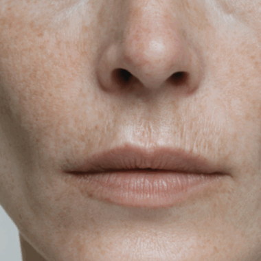 Formation des rides, effet tenseur