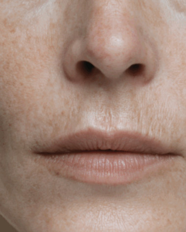 Formation des rides, effet tenseur